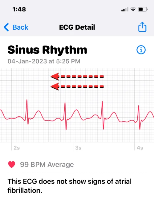 Apple Watch에 ECG 기록: 단계별 가이드
